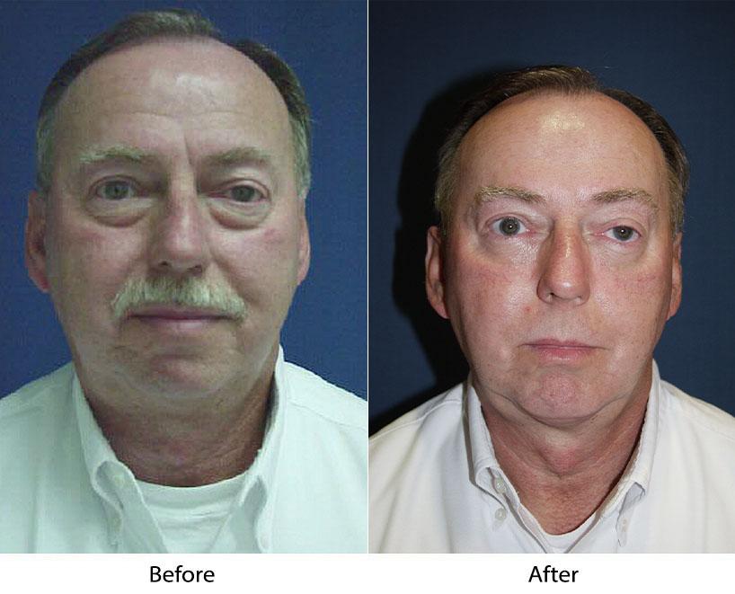 Facial plastic surgery specialist in Charlotte offers tips for men