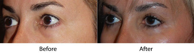 Eyelid Surgery with SOOF lift by Dr Sean Freeman