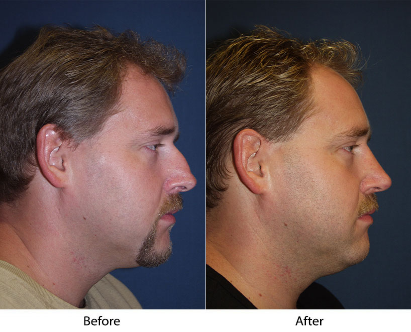 A nose job surgeon in Charlotte NC can improve the shape of your nose