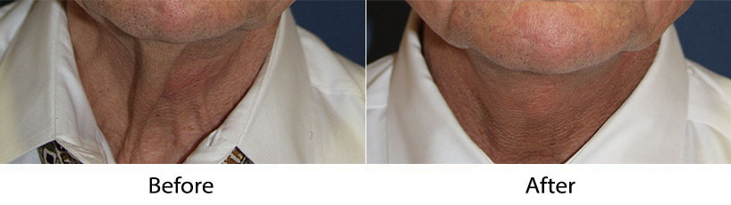 Facial Plastic Surgeon for neck lift