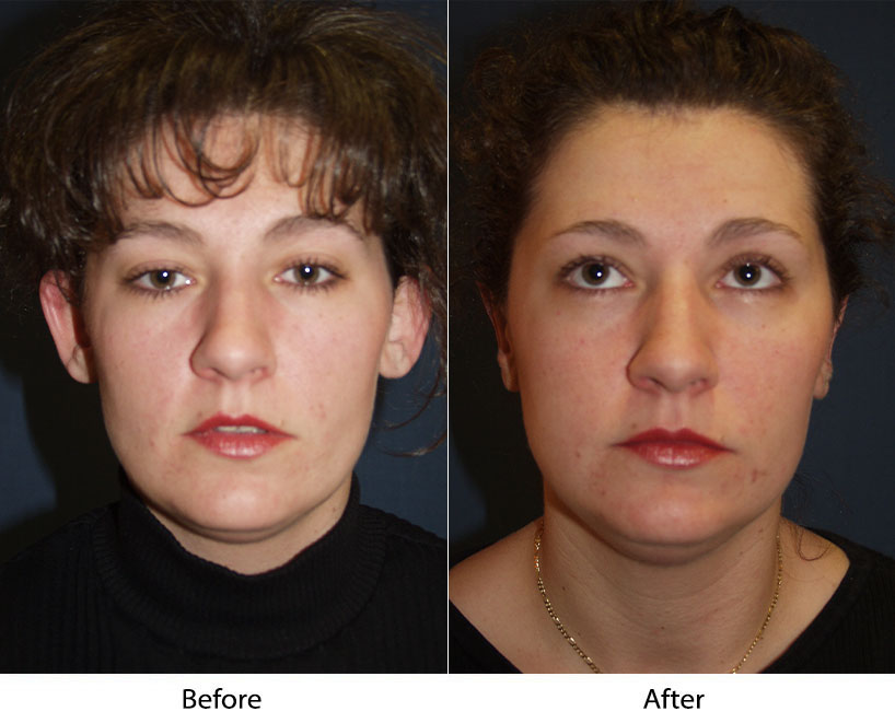 Otoplasty, ear surgery, by Charlotte's top facial surgeon
