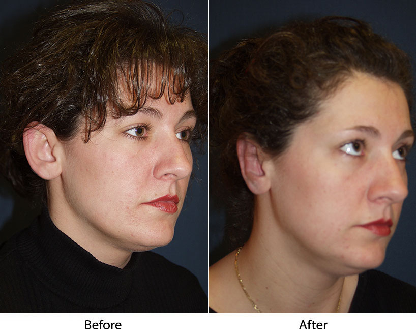 Otoplasty, ear surgery, by Charlotte's top facial surgeon