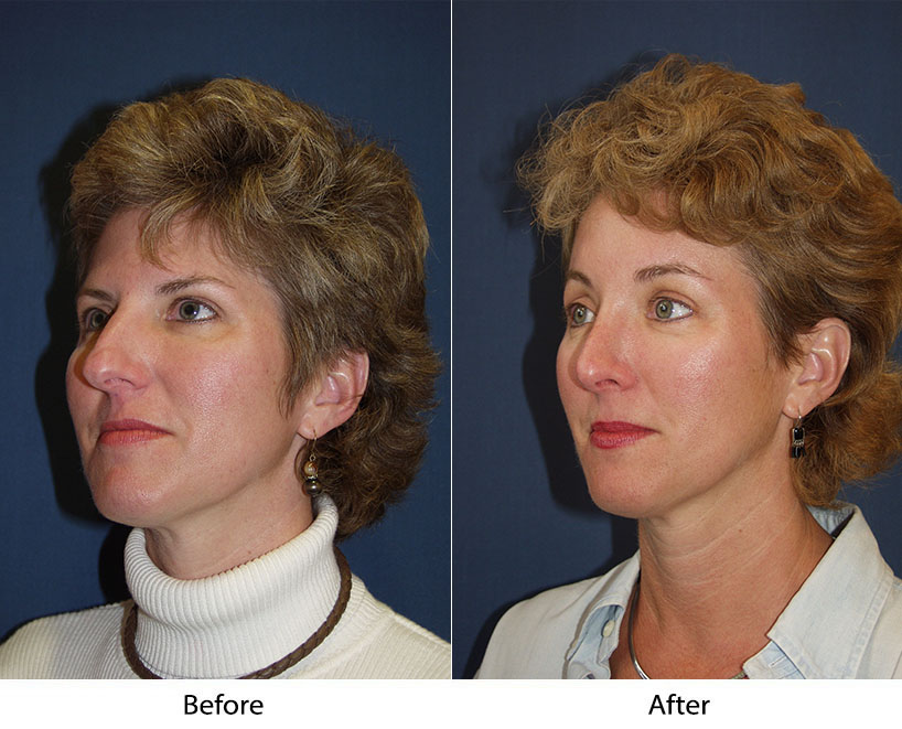 The best Charlotte facial plastic surgeon for rhinoplasty surgery