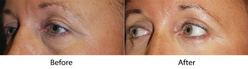 Eyelid surgery by Dr. Sean Freeman
