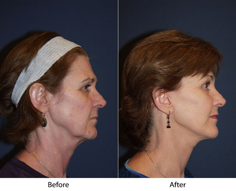 Facelift surgeon in Charlotte NC explains key facts in facelifts on balding men