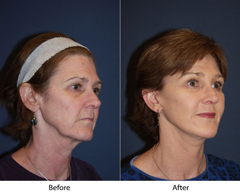 Deep Plane Facelift and Endoscopic Brow Lift
