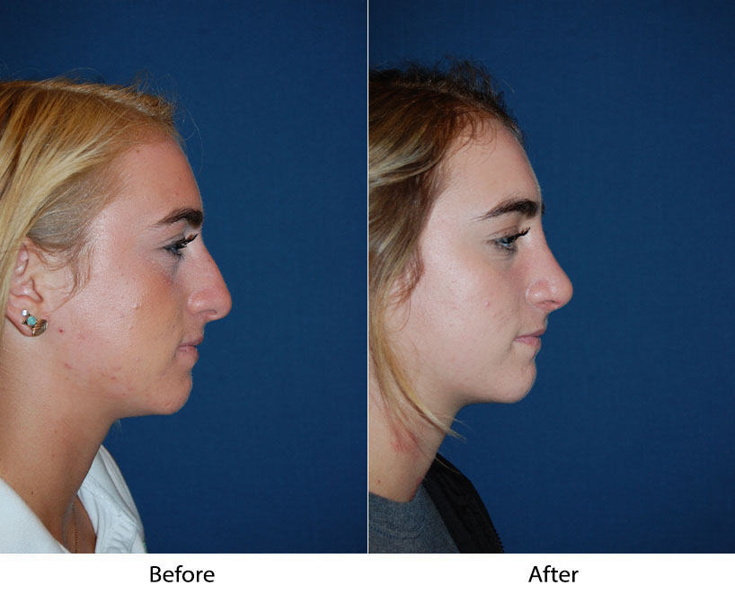 Rhinoplasty by Charlotte's top nose surgeon