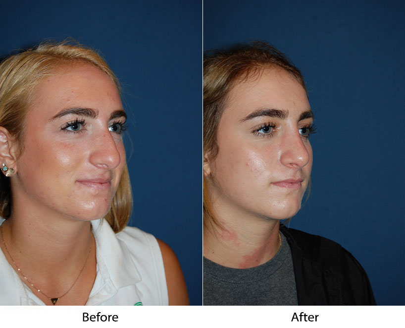 How a rhinoplasty can improve the appearance