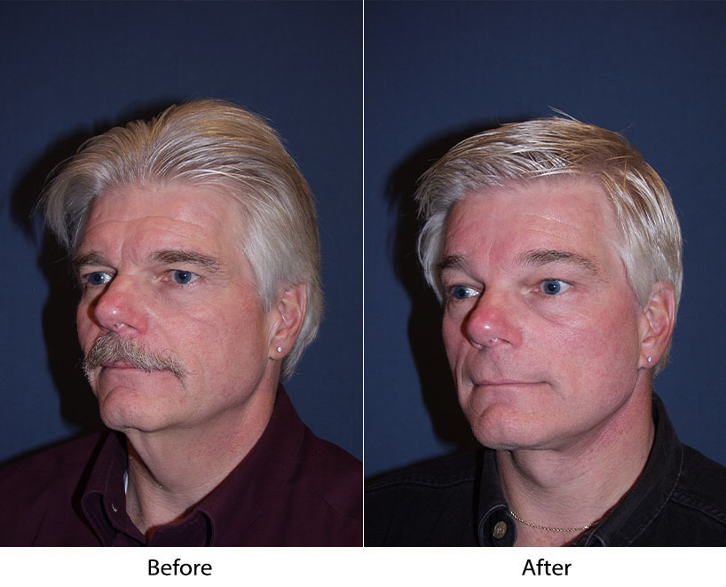 Brow lift surgery via endoscopic procedure for residents in Charlotte, NC