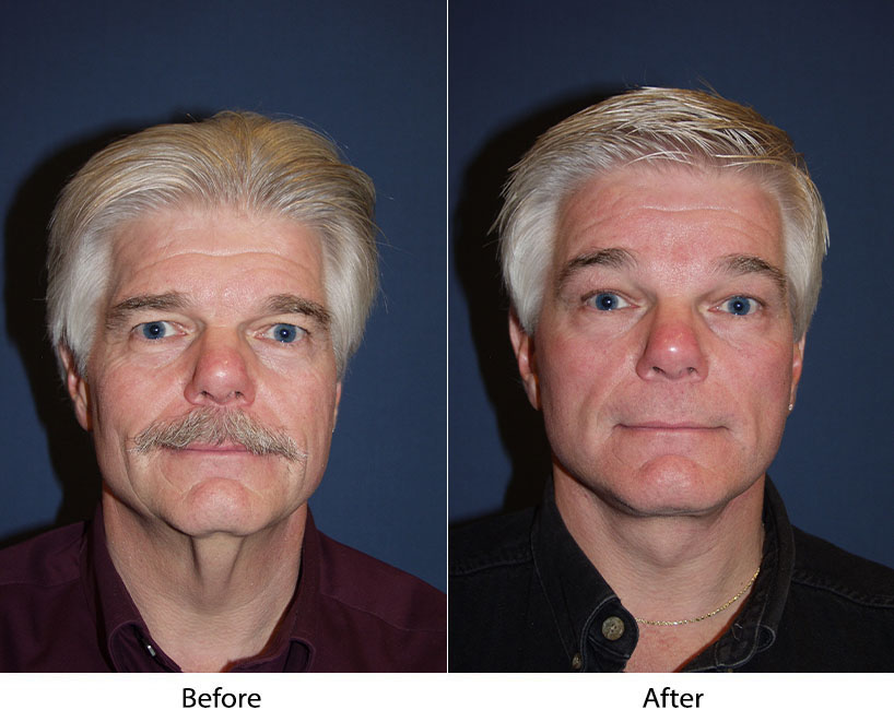 Best facial plastic surgeon in Charlotte, NC for a youthful look