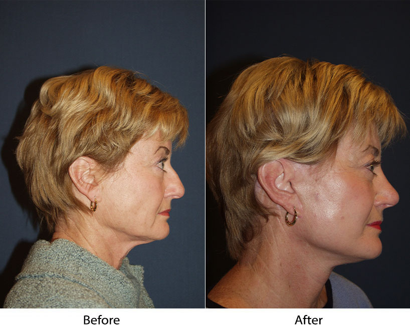 How a rhinoplasty can improve your appearance