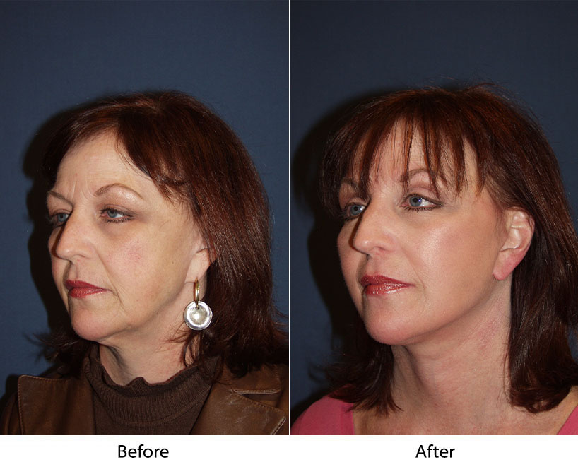 Face lift by Charlotte's top facial plastic surgeon