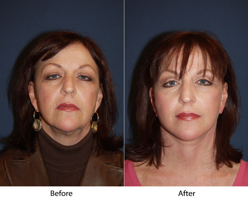 Facelifts — great skill, great improvement