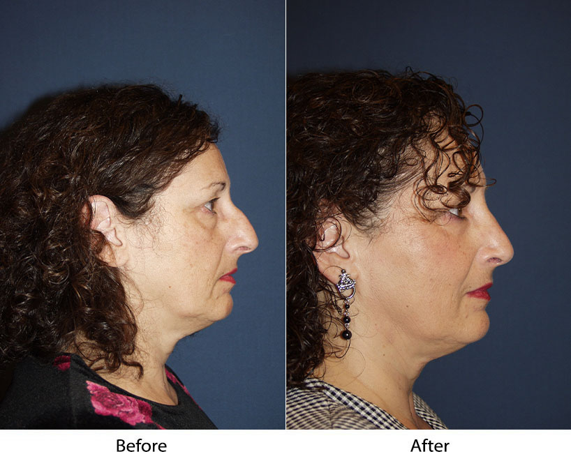 Understanding revision rhinoplasty in Charlotte NC: Call the top nose surgeon