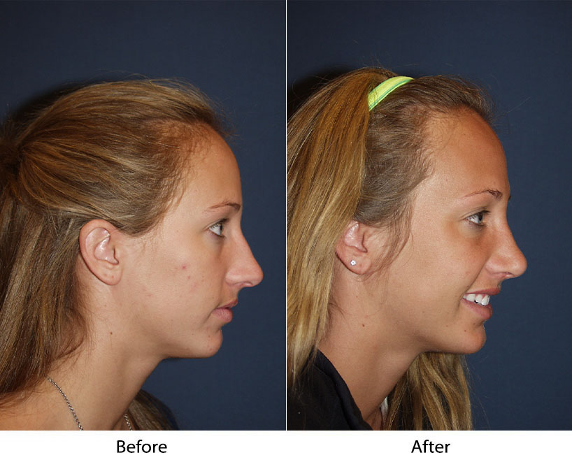 Charlotte’s top rhinoplasty surgeon can improve the appearance of your nose