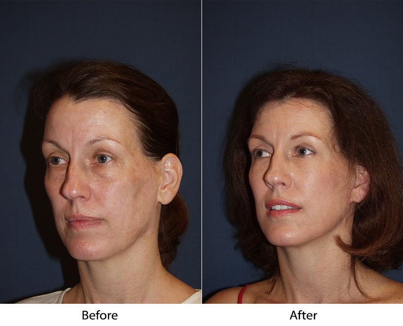 Lower lid “SOOF” lift blepharoplasty benefits: top Charlotte facial plastic surgeon