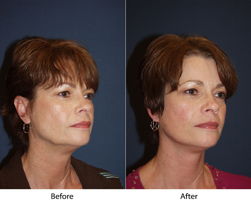 Signature face lift by Dr. Sean Freeman