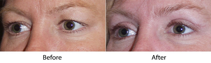 Eye lift surgery by Charlotte's top facial plastic surgeon
