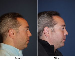 Rhinoplasty with Chin and Cheek Implants