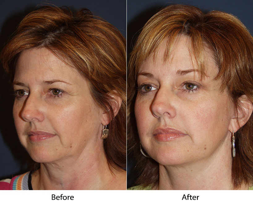 Face lifts restore appearance of youth