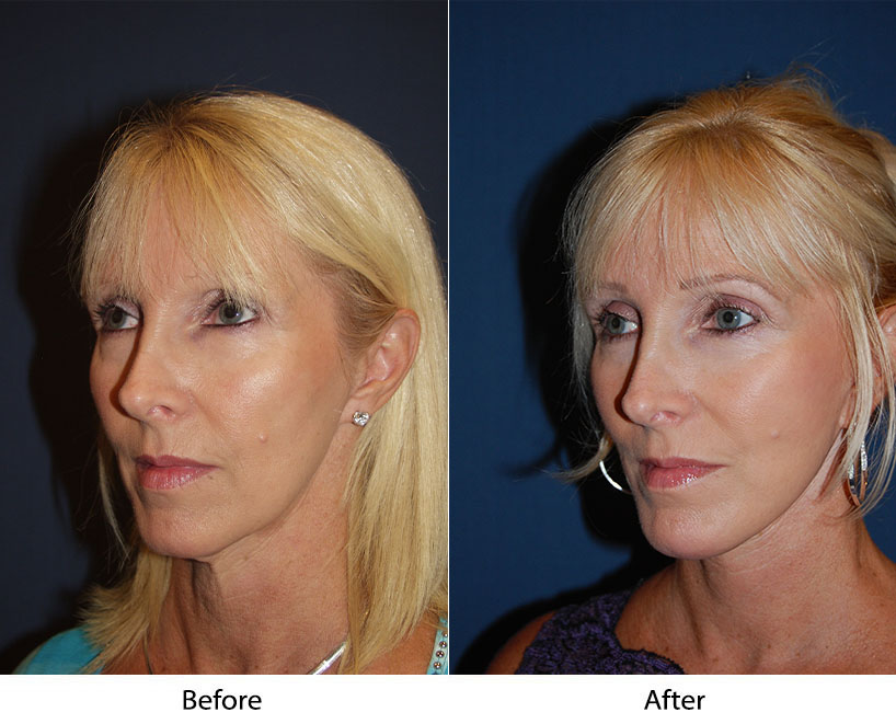 Face lifts in Charlotte, NC