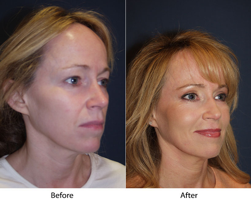 Signature Lift with Cheek Implants