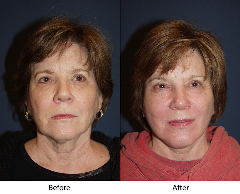 Lateral Brow Lift - endoscopic brow lift by Dr. Sean Freeman