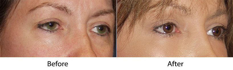 Lower eyelid SOOF surgery from Charlotte's top facial plastic surgeon