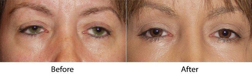 Eyelid surgery from Charlotte's top facial plastic surgeon