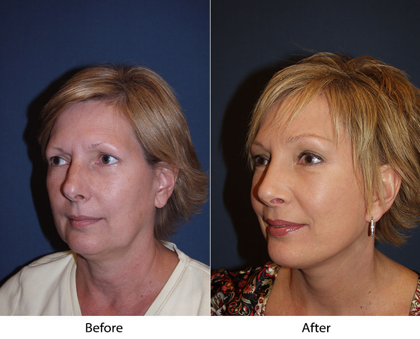 Best brow lift from best facial plastic surgeon in Charlotte NC: benefits to consider