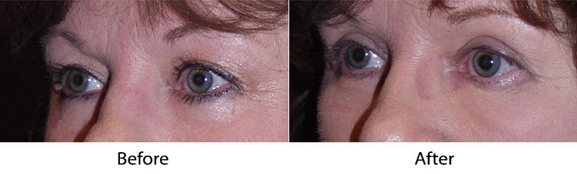 Can Charlotte, NC eyelid surgery really make me look young?
