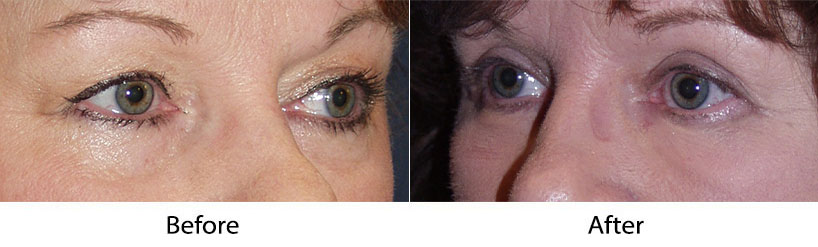 Eyelid surgery from Charlotte's top facial plastic surgeon