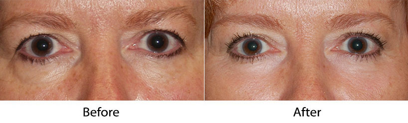 Eye lift surgery and how to prepare for it