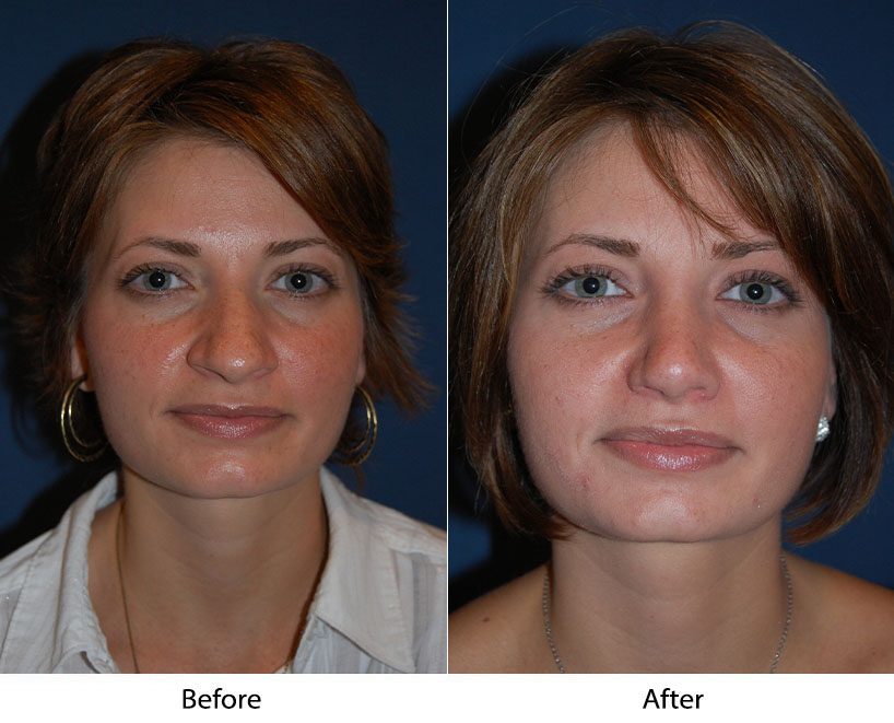Nose jobs from Charlotte’s top cosmetic surgeon