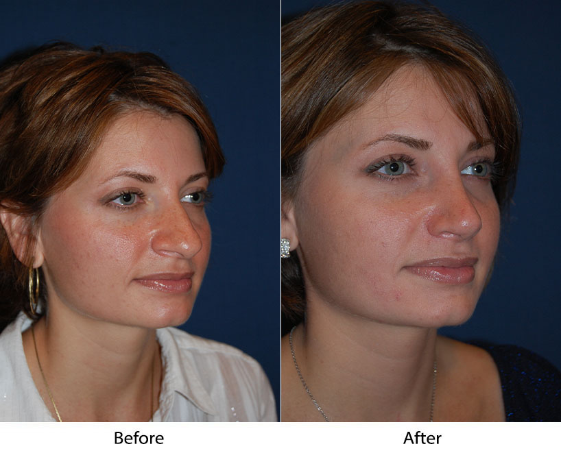 Charlotte’s best rhinoplasty expert answers nose job revision procedure questions