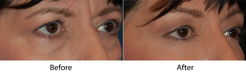Best eyelift surgeon in Charlotte NC explains what to do after lower eyelid surgery