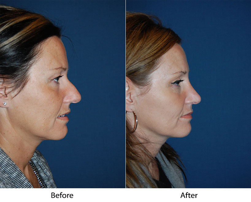 Best Charlotte rhinoplasty surgeons and how to recognize them