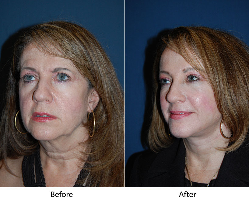 Best facial plastic surgeon in Charlotte NC: typical procedures