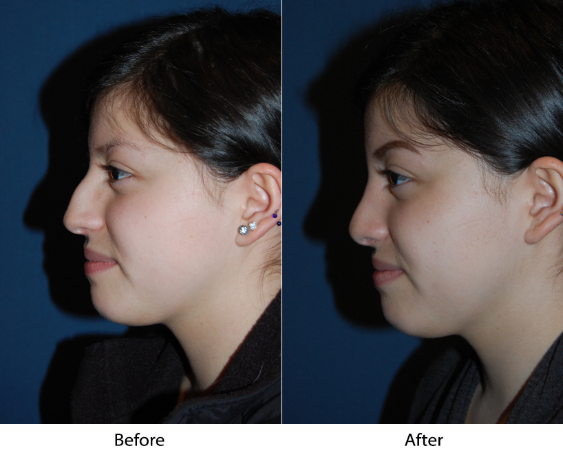 Rhinoplasty specialist in Charlotte NC explains what affects the success rate of most procedures
