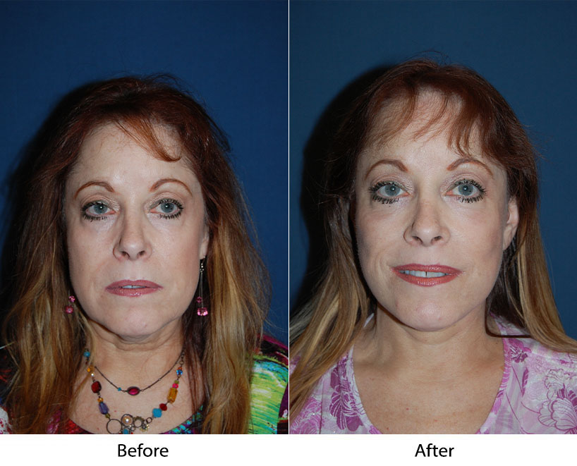 Best Soof lift blepharoplasty in Charlotte, and why you need it