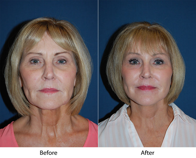 For the best results choose Charlotte’s most experienced rhinoplasty surgeon