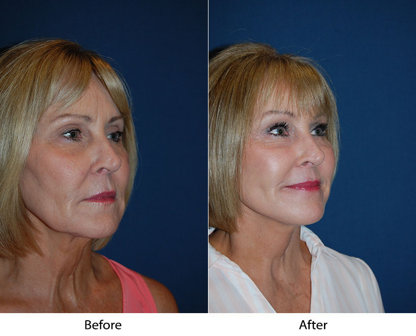 Brow lift surgery steps from Charlotte’s top facial plastic surgeon