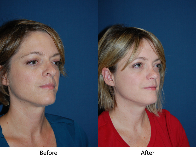 Charlotte’s top facial plastic surgeon helps you get the look you deserve