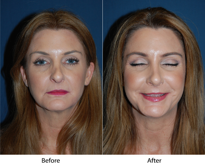 Facial plastic surgery best done by experts