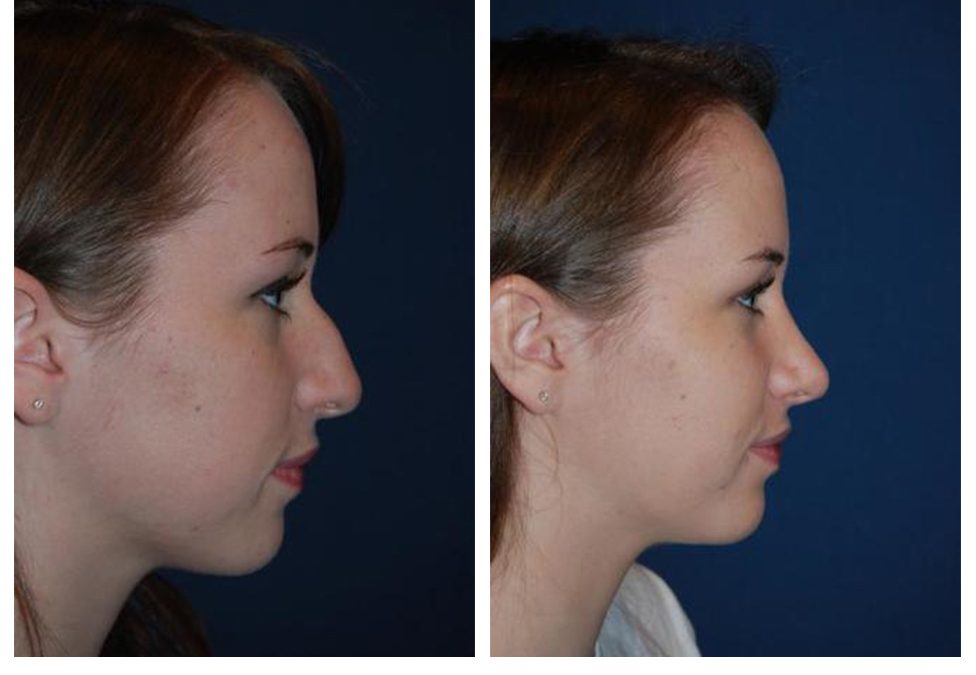 Best Charlotte Rhinoplasty surgeon: top nose job near me
