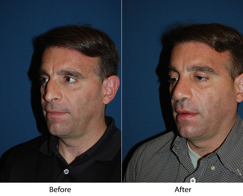 Rhinoplasty — recovery and revision