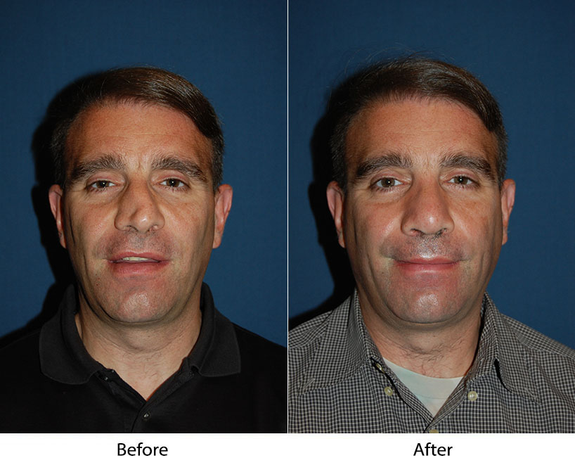 Rhinoplasty and the male and female nose