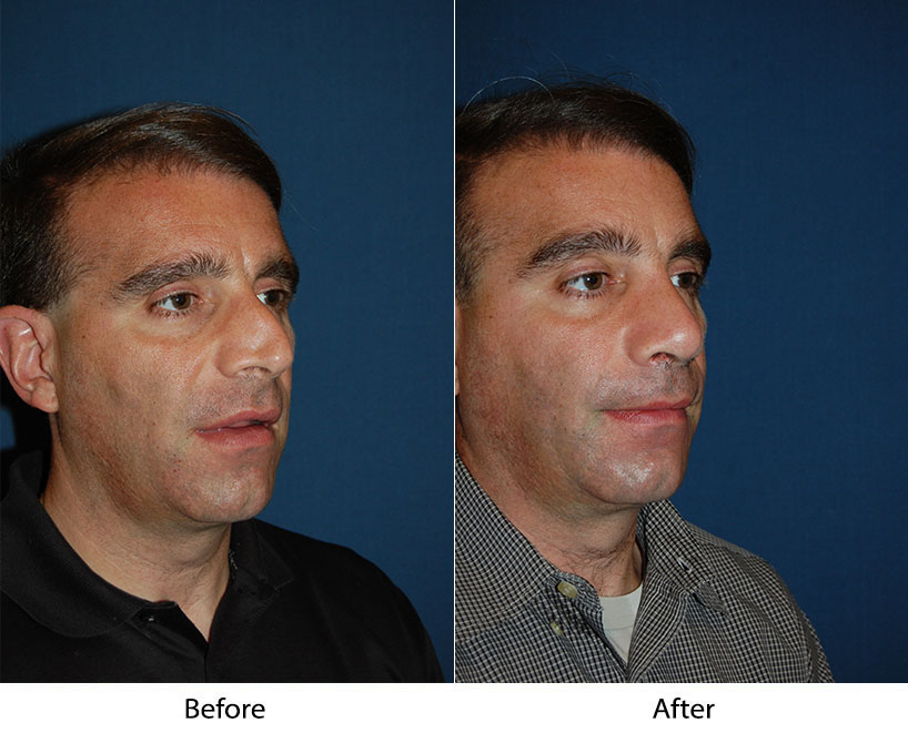 A story of cosmetic surgery or Rhinoplasty