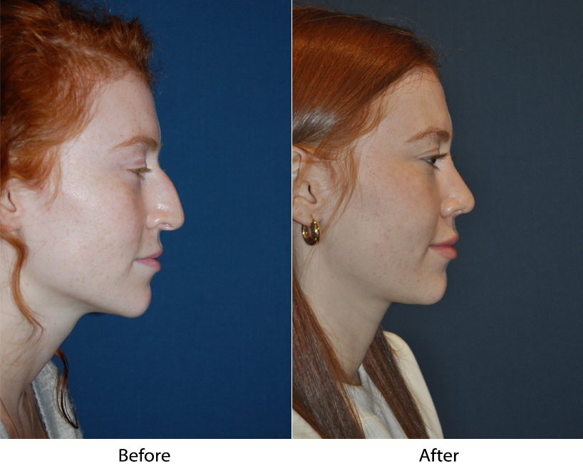 Different noses, different rhinoplasties