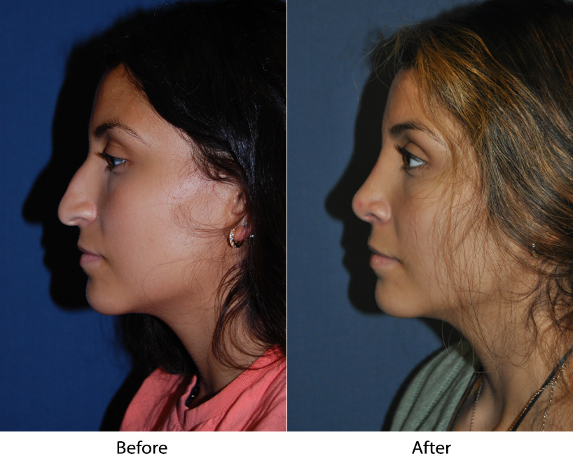Ethnic Rhinoplasty by Charlotte's top nose job surgeon